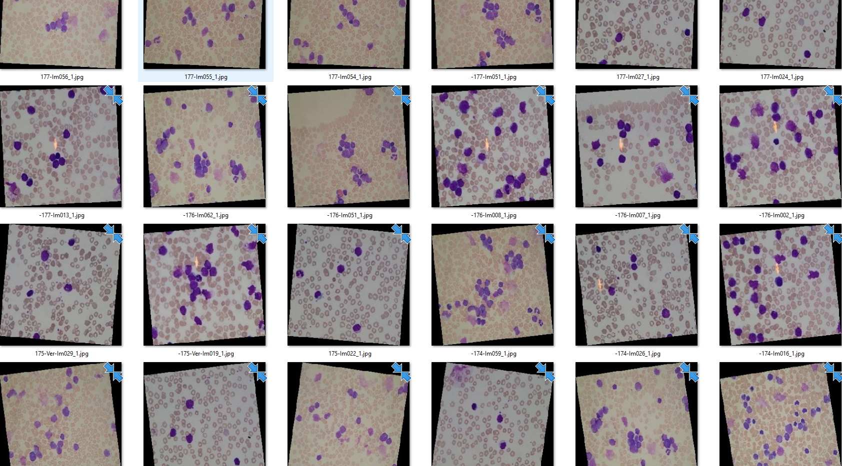 Peter Moss Acute Lymphoblastic Leukemia Detection System 2019 Intel