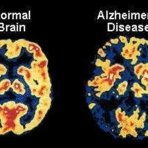 Alzheimer's Detection