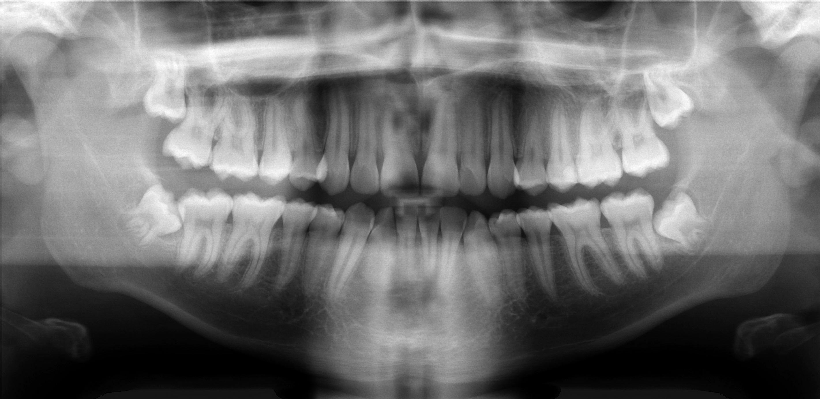 RealTime Dental Caries detection from XRay images Intel DevMesh