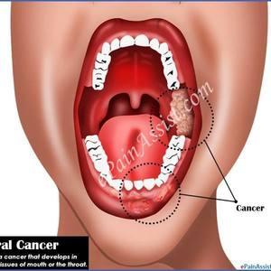 Mini oral cancer