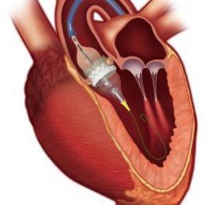 A Self-Expanding TAVR, EDWARD SAPIEN 3 transcatheter heart valve.