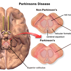 Mini blausen 0704 parkinsonsdisease