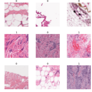 Breast cancer detection using deep learning