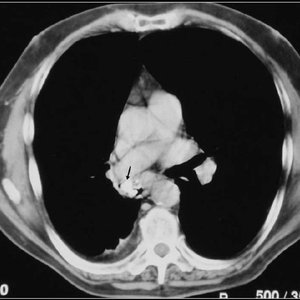 Lung Diseases Detection using Semantic and Instance Segmentation on Dicom images 