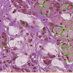 Signet-ringcell-detection