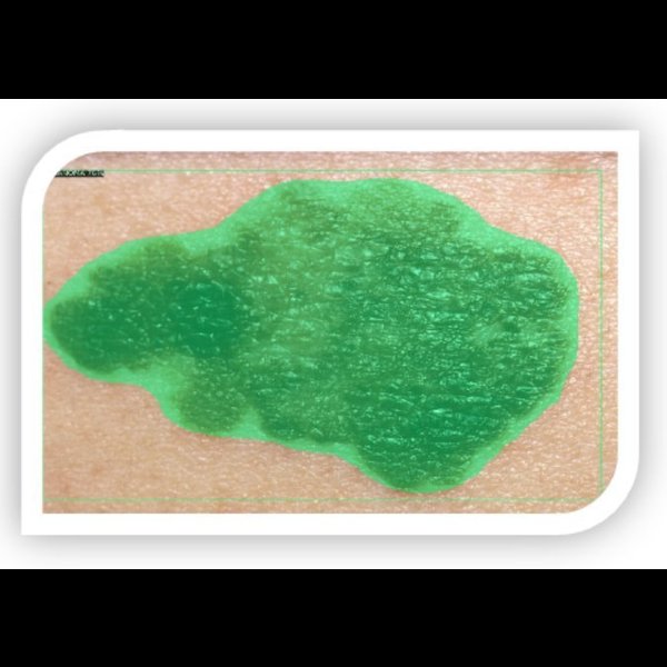 DERMATO.AI : Skin Disease Detection Using AI 