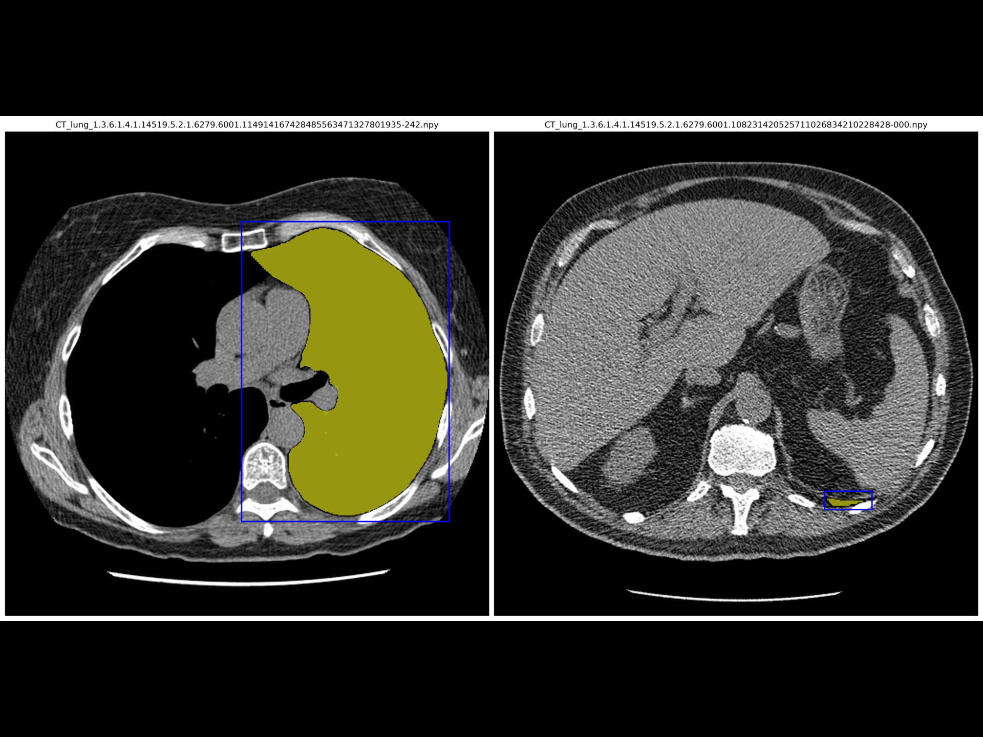 Deep Learning for Lung Cancer Diagnosis