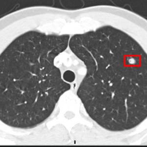 Lung Nodule Malignancy Prediction, Based on Sequential CT Scans
