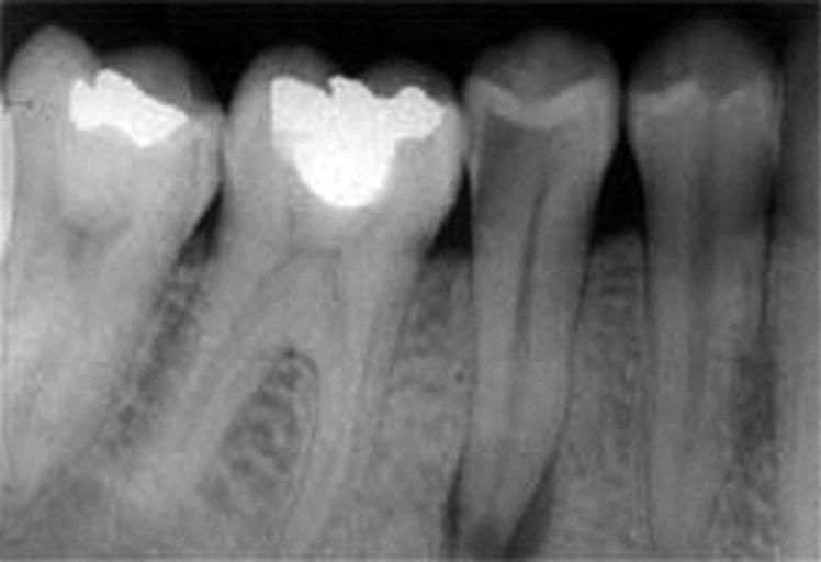 RealTime Dental Caries detection from XRay images Intel DevMesh
