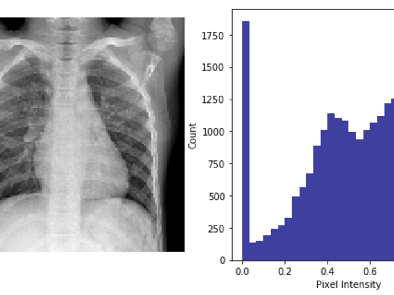 Identifying Viral and Bacterial Pneumonia from Chest XRay Images using
